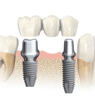 Studio Dentistico Semeghini Mauro_Implantologia