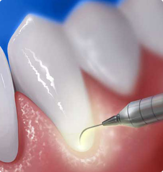 Studio Dentistico Semeghini Mauro_Parodontologia